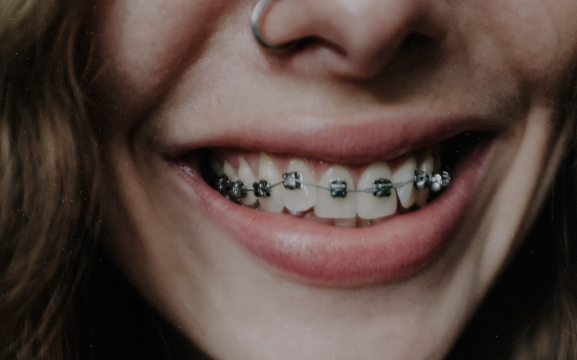 ¿Se Pueden Caer Los Dientes Por Los Brackets? Te Explicamos - El Sol De ...